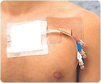 BX/50 - Cath-Strip Reclosable Catheter Fastener
